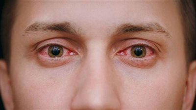 أستاذ عيون: علامة واحدة تكشف إصابة الشخص بكورونا