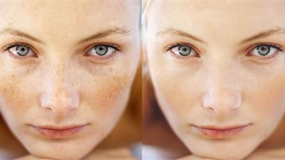 3 وصفات طبيعية غير مكلفة للتخلص من النمش نهائيا