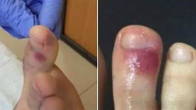 أعراض جديدة لكورونا.. انتبه لقدميك