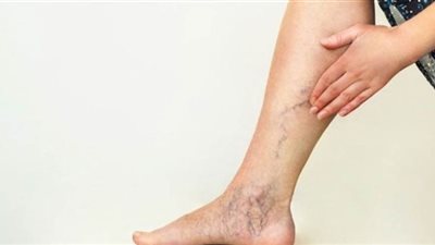 السمنة وقلة الحركة يرفعان مخاطر الإصابة بدوالي الساقين
