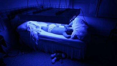 طلب إحاطة لتوفير علاج لمرض متلازمة كريغلر نجار