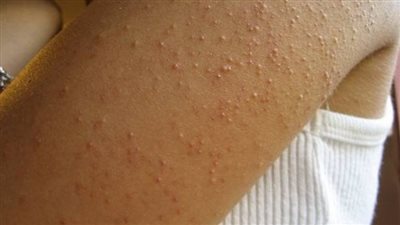 جلد الوزة.. أسباب الإصابة وطرق العلاج