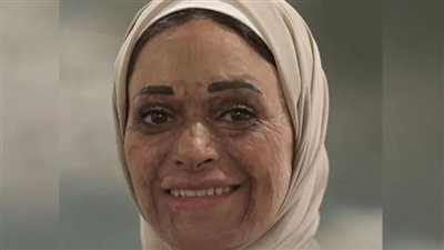 كتب تعليق صادم.. العقوبة المتوقعة لصاحب واقعة التنمر على الناجية من الحروق 