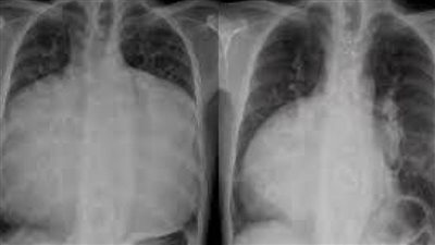 حالة نادرة لقلب رجل يملأ صدره بالكامل