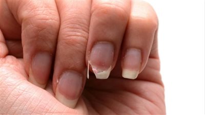 أعراض نقص الكالسيوم بالجسم.. وطرق علاجه من الطبيعة