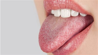  أسباب جفاف الفم وطرق علاجه والوقاية منه