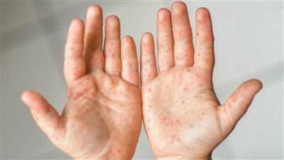 مرض فيروسي شائع لدى الأطفال.. كل ما تريد معرفته عن داء يد فم قدم