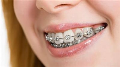 هل يوجد عمر معين لإجراء تقويم الأسنان ؟ الصحة تجيب