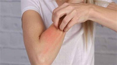 ما هي حساسية الدواء وأهم أعراضها الجانبية ومخاطرها