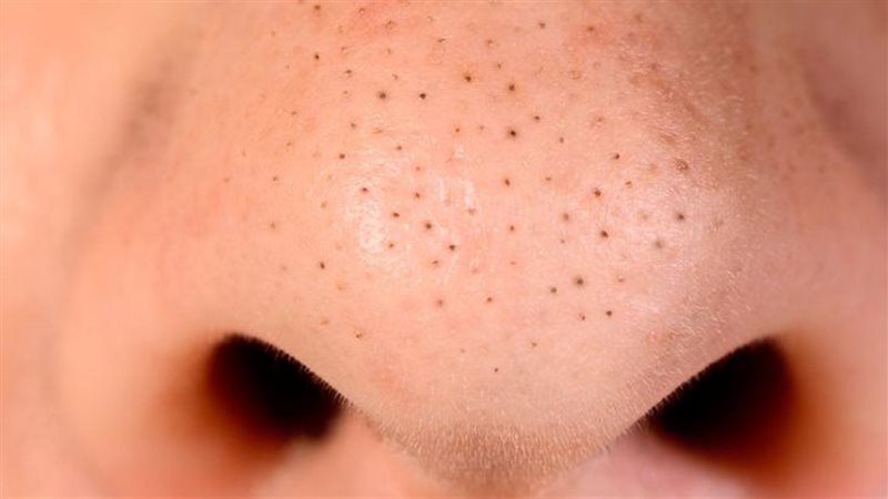 طرق التخلص من البثور