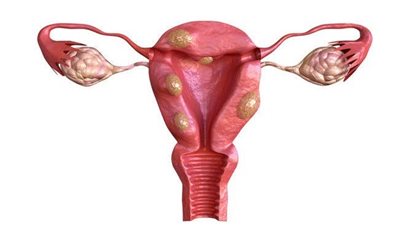  طرق علاج بطانة الرحم المهاجرة للسيدات