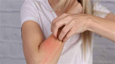 هيئة الدواء تحذر من حساسية مفرطة للأدوية وتكشف الأعراض