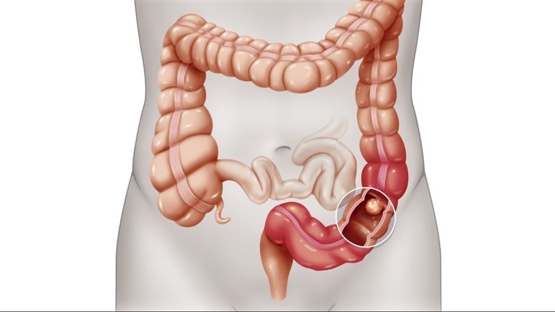 أعراض انسداد الأمعاء