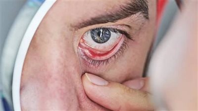 يسبب فقدان النظر.. كل ما تريد معرفته عن مرض المياه الزرقاء على العين