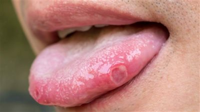 مرض بهجت وتأثيره على الكلى والحمل