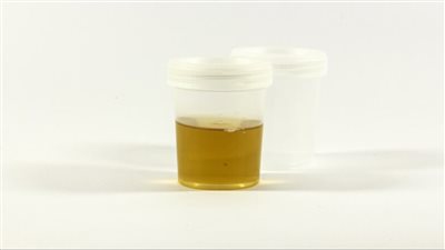 أعراض زيادة الأملاح والصديد في البول وطرق الوقاية منها