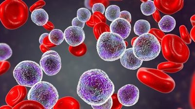 الأعراض الأولية والمتقدمة لسرطان الدم