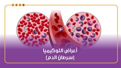 أعراض اللوكيميا (سرطان الدم) | إنفوجراف