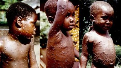 بعد انتشاره في أوروبا.. خبير يكشف الفرق بين انتشار كورونا وجدري القرود