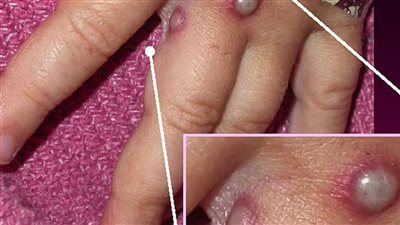 شبح الانتشار الواسع يخيم على العالم.. معلومات يجب أن تعرفها عن «جدري القرود»