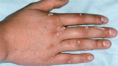 لتوخي الحذر.. 8 معلومات ثبتت صحتها علميا عن جدري القرود