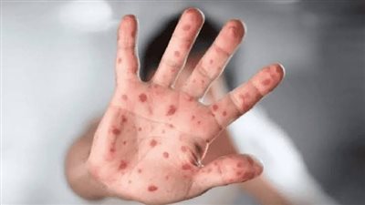 أخبار مصر: حقيقة ظهور جدري القرود بمصر.. بن شرقي يوقع للأهلي.. اللحظات الأخيرة بحياة سمير صبري وموقف ابنه من حضور جنازته 