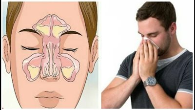 علاج الجيوب الأنفية نهائيا بالمواد الطبيعية