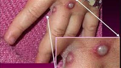 بيان مهم من الصحة السعودية بشأن جدري القرود