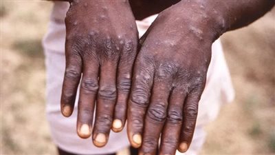 الصحة العالمية تعلن حصيلة مصابي جدري القرود في العالم