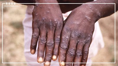 لماذا سمي جدري القرود بهذا الاسم؟ | فيديو جراف