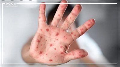 أعراض الإصابة بمرض جدري القرود وطرق انتقاله للبشر