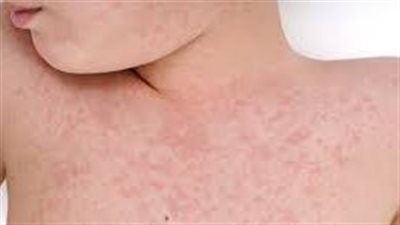 إغلاق رياض الأطفال في ماليزيا بعد انتشار مرض غريب