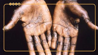 جائحة جديدة.. لماذا يرعب جدري القرود العالم؟| فيديوجراف 