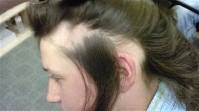 أسباب الثعلبة وأنواعها وطرق العلاج | فيديو 