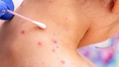 أعراض مهمة لو ظهرت عليك يجب الذهاب لأقرب مستشفى حميات 