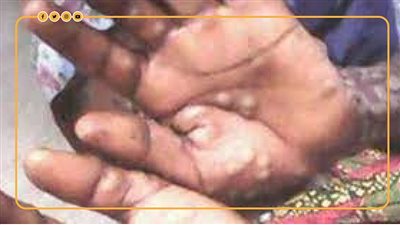 بعد اعتباره جائحة.. 4 سيناريوهات كارثية لتفشي جدري القرود| فيديوجراف