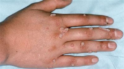 اسكتلندا تؤكد أول إصابة بجدري القرود