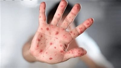 الصحة تكشف الفرق بين الجديري المائي وجدري القرود 