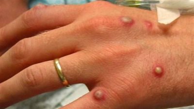 بريطانيا تسجل 36 إصابة جديدة بجدري القرود 