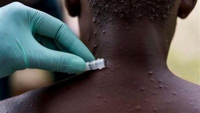 دولة جديدة تسجل أول إصابة بجدري القرود