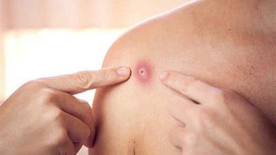 ارتفاع إصابات جدري القرود في هذه الدول