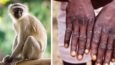 الصحة العالمية: جدري القردة يتحرك بطريقة غير اعتيادية مقارنة بموجات الانتشار السابقة