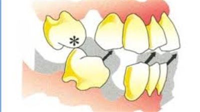 أضرار ومخاطر فقد الأسنان