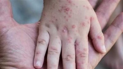 بشرة خير.. اختبار لقاح جديد للوقاية من جدري القرود