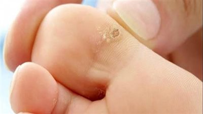 ما هو كوللوماك محلول لعلاج عين السمكة؟