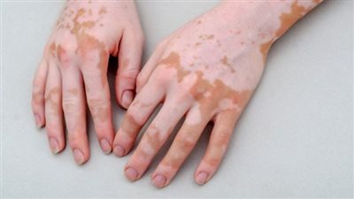 تفسير حلم مرض البهاق في المنام وعلاقته بالخير