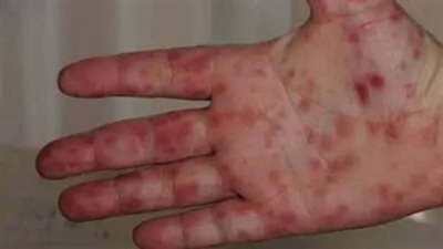 أعراض وأسباب مرض إنفلونزا الطماطم 