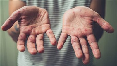 جدري القردة.. 6 خرافات عن الفيروس سببها الرعب العالمي