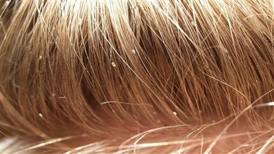 أخصائي طب أطفال يكشف طرق علاج القمل في الشعر نهائيا