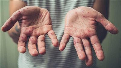 قمة جبل الجليد.. تصريح 